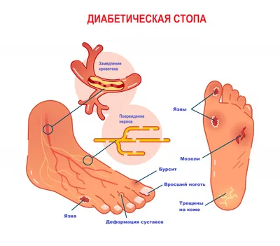 Диабетическая остеоартропатия (стопа Шарко) - charcotfoot.ru - Лечение стопы  Шарко в Москве