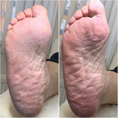 https://ortomed-clinic.ru/articles/hallux-valgus/shishka-na-vneshney-storone-stopy/