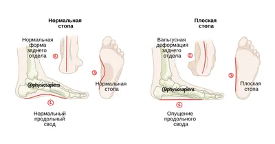 Деформация стопы — лечение бесплатно по ОМС