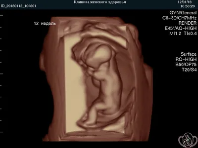 Фото УЗИ при беременности - «Ошибка пола в наше время? Возможна!)» | отзывы