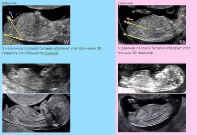 Определение пола ребёнка на ранних сроках беременности. 👫 ⠀ Определение  пола на первом скрининге УЗИ, а это 12-13 недель беременности… | Instagram