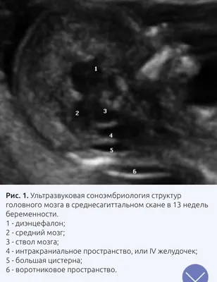 УЗИ на ранних сроках беременности | ЦПС Медика