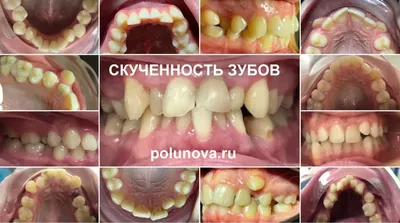 Нужно ли удалять зубы мудрости: нужны ли зубы мудрости, советы экспертов.