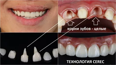 Виды и отличия имплантации зубов - Cтоматология Май