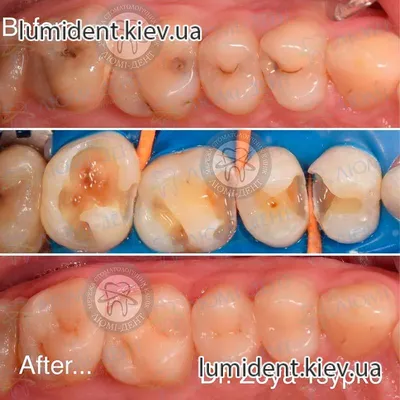 Пломбирование Зубов 229 Фото До После ЛюмиДент