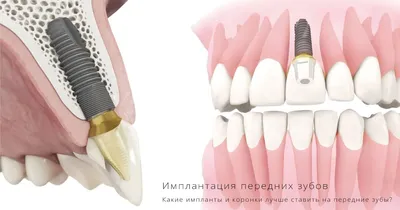 Что такое протезирование зубов? • Узнаем больше с Вальдорф