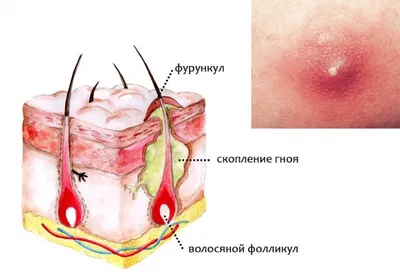 Фурункул и фурункулез: причины, симптомы, диагностика и лечение