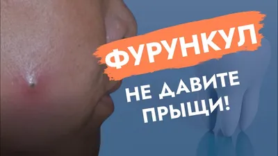 Фурункул уха – Uclinic