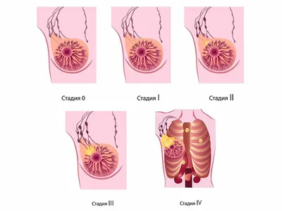Рак молочной железы - диагностика, симптомы, стадии, первые признаки и  лечение в СПб | Клиника МедПросвет
