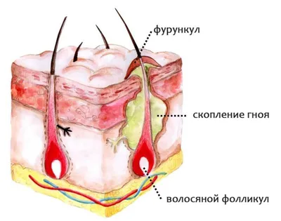 Антисептическое средство МосФарма \"ИХТИОЛ\" - «Жалкая попытка вылечить  гнойный прыщ + (Фото До и После)» | отзывы