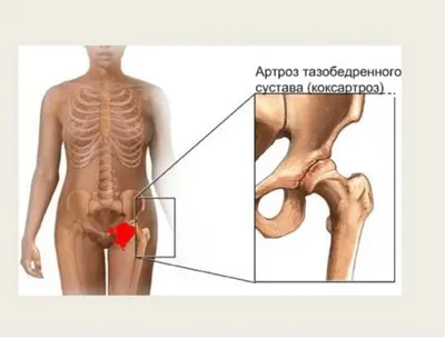 Трофическая язва на ногах: симптомы, причины, лечение трофических язв  нижних конечностей – Отделение флебологии – НКЦ №2 (ЦКБ РАН) в Москве