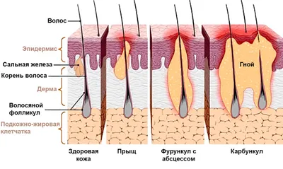 Фурункул стадии развития фото