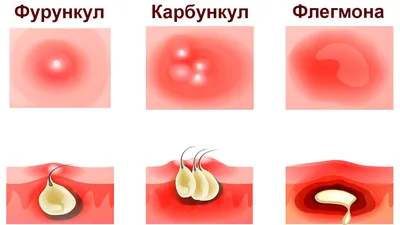 Лечение и удаление фурункула в СПб - описание, цены