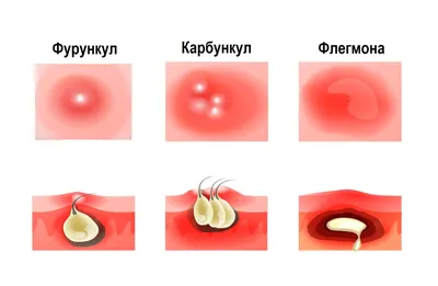 Фурункулез: симптомы, причины, лечение, профилактика