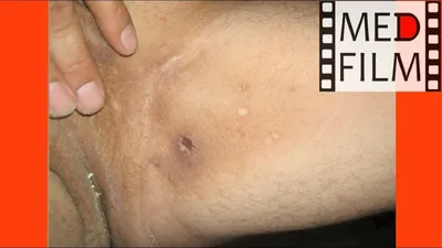 The inguinal epidermophytosis © - YouTube