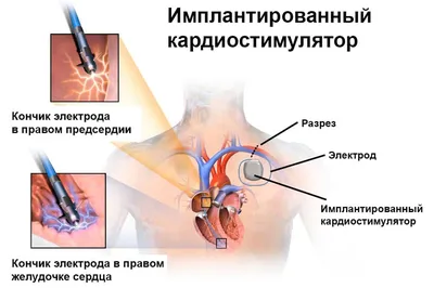 Киста копчика (эпителиальный копчиковый ход)