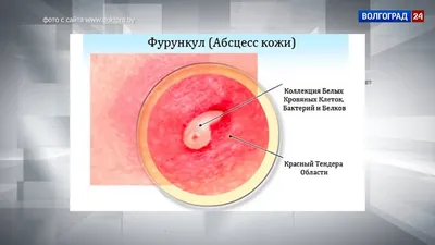 Как быстро вылечить фурункул и карбункул в домашних условиях | Солнышко