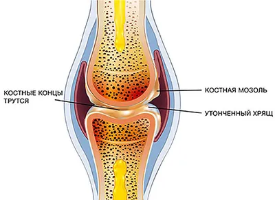 Симптомы и признаки эпителиальной кисты копчика: что нужно знать