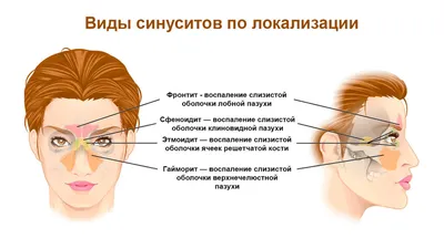 Гайморит: признаки, симптомы, лечение - МедКом