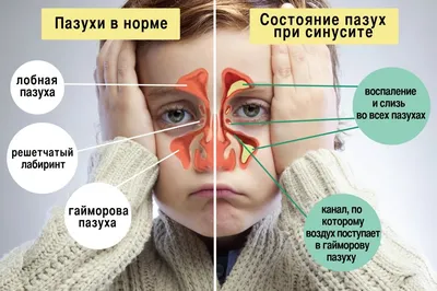 Как Лечить Гайморит (Синусит) Симптомы 100% Информации и Пользы