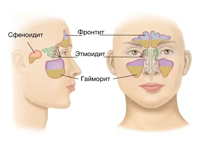 Гайморит: признаки, симптомы, лечение - МедКом