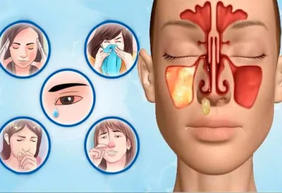 Профилактика гайморита - причины появления, как понять что болезнь началась  и как правильно её лечить