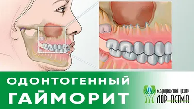 Гайморит симптомы у взрослых и его быстрое лечение