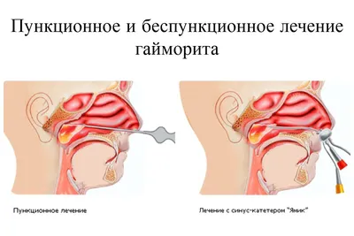 ГАЙМОРИТ | Флюорография | Оздоровительный центр Шаритель в Киеве