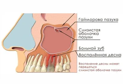 Гайморит - это не прокол | Доктор Лесков | Дзен