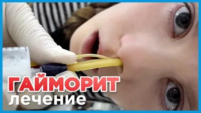 Как лечить гайморит в домашних условиях - самое важное