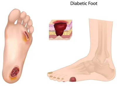 Лечение трофической язвы в Клиническом центре Сеченовского Университета