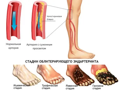 Почему врастает ноготь и как эффективно лечить вросший ноготь?