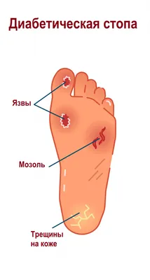 Вальгусная деформация (Hallux valgus) – причины, стадии, классификация и  лечение в «Будь Здоров»