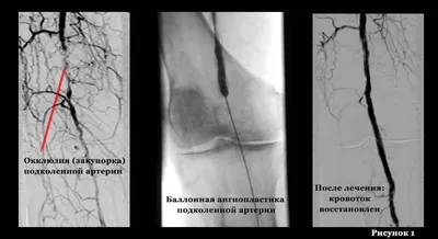 Трофические язвы: причины, симптомы, лечение, профилактика, диагностика