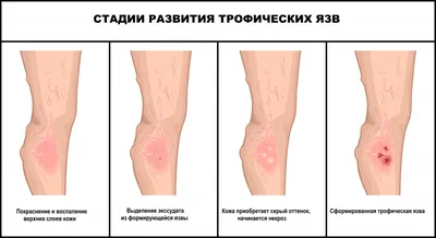 Удаление вросшего ногтя в Москве|Стоимость операции в клинике|удалить  вросший ноготь по низкой цене