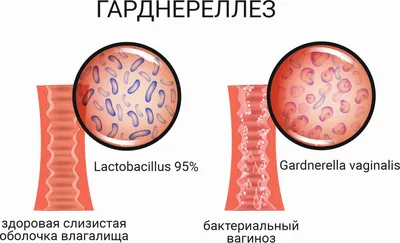 Гарднерелла у женщин и мужчин, лечение гарднереллеза, откуда он берется,  симптомы