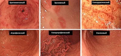 Гастрит: симптомы и лечение у взрослых, причины, классификация, диагностика  и осложнения гастрита желудка