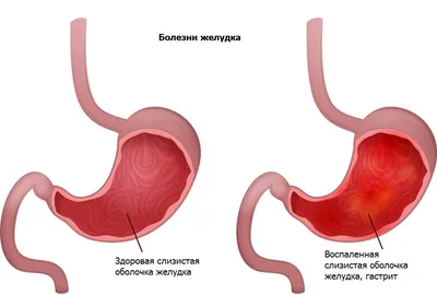 ГАСТРИТ: СИМПТОМЫ И ЛЕЧЕНИЕ - Kupffer BiothechKupffer