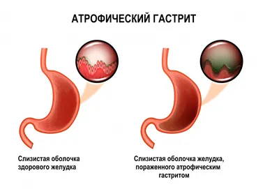 Гастрит | Статьи клиники \"УРО-ПРО\"