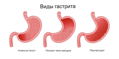 Гастрит | Что это такое, симптомы, признаки и лечение желудка