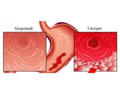 Атрофический гастрит - причины появления, симптомы заболевания, диагностика  и способы лечения