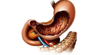 Гастрит: симптомы и лечение