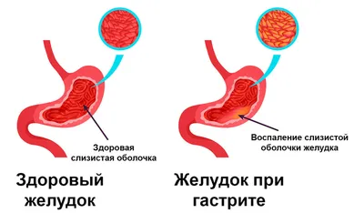 Гастрит: острый и хронический. Диагностика и лечение в МДЦ «ОЛИМП»