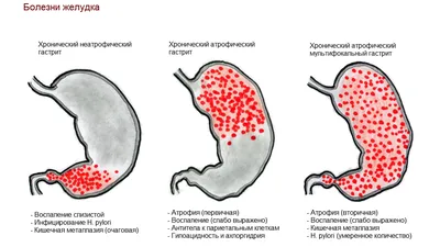 Гастрит - виды, симптомы и лечение гастрита