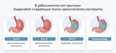 Хронический гастрит: симптомы, причины, диагностика, лечение | АО  «Медицина» (клиника академика Ройтберга)