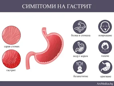 Названы основные причины появления гастрита