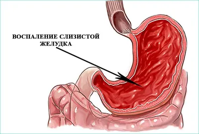 Профилактика гастрита: виды, признаки, причины возникновения, лечение