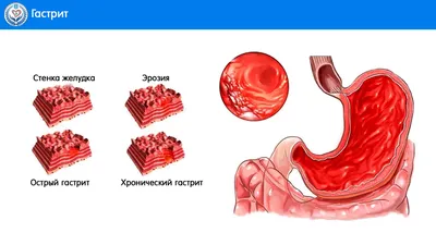 Учреждение здравоохранения \"Щучинская центральная районная больница\" -  Хронический гастрит