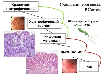 Хронический гастрит: причины, симптомы, диагностика и лечение