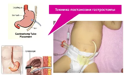 Гастростома. Почему? И кому? | МУКОВИСЦИДОЗ-РОССИЯ